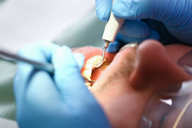 Best Emergency Tooth Extraction in Lancaster, TX