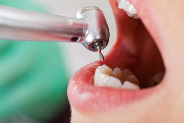 Best Emergency Tooth Extraction in Lancaster, TX